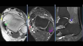 MRI Ankle Case 06