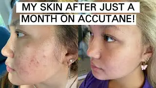 my accutane journey month 1