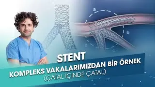 STENT | Çatal İçinde Çatal Vakası