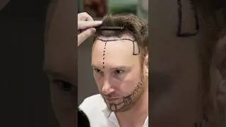 Cosmedica Clinic Hair Transplant in Turkey 