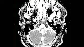 Brainstem Glioma
