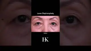 Before & After Photos Lower Blepharoplasty Surgery by Dr. Khorasani | Quadruple Board Cert Surgeon