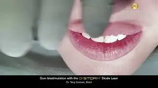 Gum biostimulation with the D-Storm™ Diode Laser