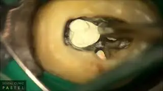 Perforation Repair with Well Root PT by Choisungbaik