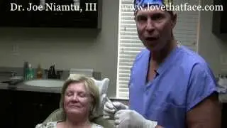 Voluma Cheek Filler Injection by Dr. Joe Niamtu, III