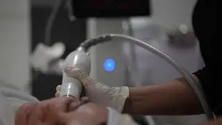 RF Microneedling