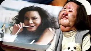 Эта девушка делала самостоятельно инъекции себе в лицо