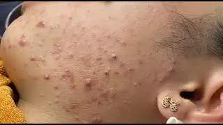 Blackhead & Whitehead Extractions (P.1) 