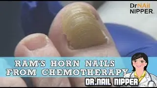 Ram's Horn Nails From Chemotherapy - Dr Nail Nipper
