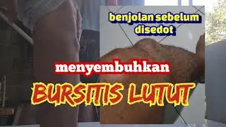 KNEE ACUTION DUE TO BURSITIS | MEDICAL TREATMENT
