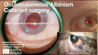 Cataract removal in patient with oculocutaneous albinism with black fiber free iris prosthesis.