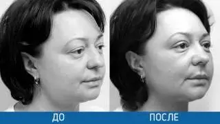 Скуловые импланты доктора Гурьянова