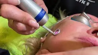 PicoWay Resolve Laser Facial in Seattle at Well Medical Arts