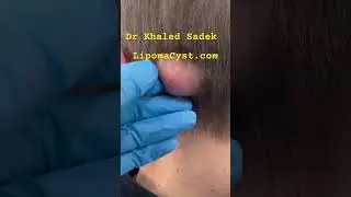 Massive Pilar cyst #skincare dr khaled sadek LIPOMACYST.com