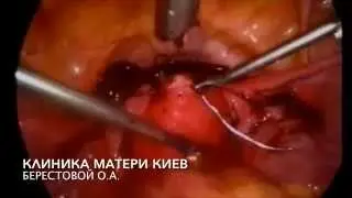 ЛАПАРОСКОПИЯ, УДАЛЕНИЕ ДЕРМОИДНОЙ КИСТЫ БЕЗОПАСНАЯ ТЕХНИКА И ФИБРОМИОМЫ