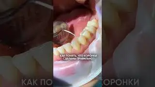Правильно сделаны коронки или нет?