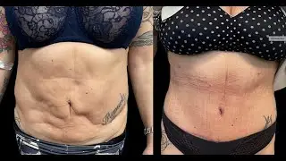 Liposuzione ultrasonica - Pre e post