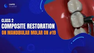 Class 2 Composite Restoration on Mandibular Molar on #19 | Caapid Simplified Bench Prep Course