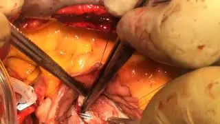 Giant Left Atrial Myxoma Resection