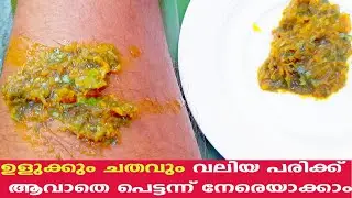 ചതവും വേദനയും കുരുക്കളും അകറ്റാം Chadhavum Vedanayum Maran | Natural Remedy for Swelling