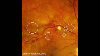 Branch Retinal Vein Occlusion #eyedisease #ophthalmology #retina