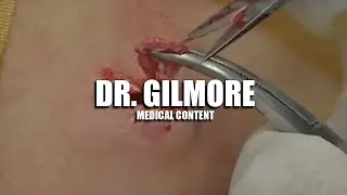 Dr. Gilmore Fan Page!   Must See Extractions