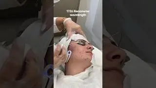 TRYING AVICLEAR FOR MY ACNE 