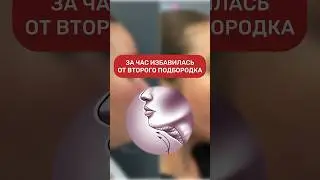 Результат липосакции подбородка
