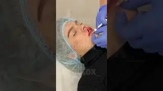 Увеличение губ. 1мл.