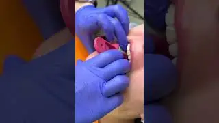 Impressions from implants with an open tray