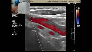 Ultrasound of the neck vessels: an anomaly of the origin was found