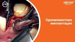 Одномоментная имплантация. Область нижнего премоляра.