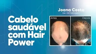 Tratamento para calvície com hair power - Dra. Joana Costa