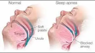 [YTP]Disturbing! Tsukasa suffers from sleep apnea | ProSekai
