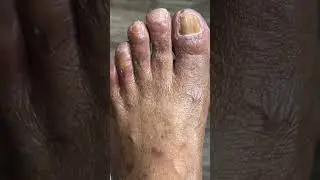All hope is not lost #feet #podiatry #footcare #fungaltoenails #athletesfoot #callusremoval
