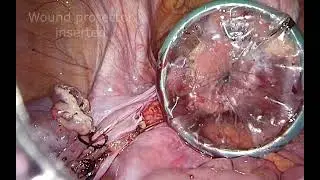 Laparoscopic sigmoid colectomy with transanal natural orifice specimen extraction