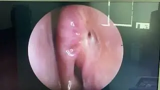 Postoperative 2-year after endoscopic endonasal dacryocystorhinostomy. The neo-ostium is patent.