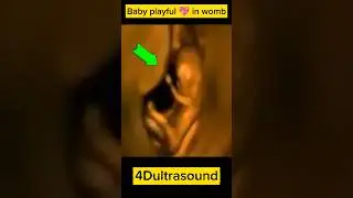 He is too excited, ultrasound #ultrasound #fetus #shorts