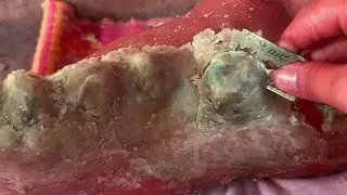 How to removal skin | callus removal skin flakes #40