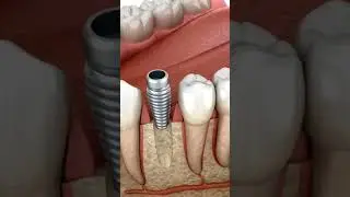 What are Dental Implants?