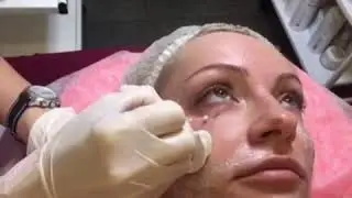 Коррекция овала лица мезонитями в клинике Аура