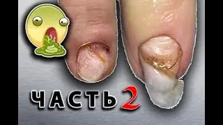 Horrible Manicure. Part 2😱 Purulent Inflammation of the Cuticle after Manicure. Lesson gel polish