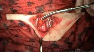 Ectopic Pregnancy. Minilaparatomy. Tubectomy