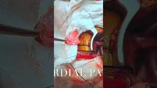 Minimally Invasive ASD Closure: Direct Cannulation 