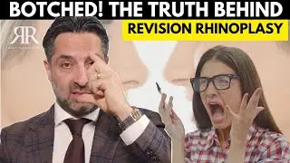 210 The Unspoken TRUTH About Revision Rhinoplasty #revision #rhinoplasty #losangeles