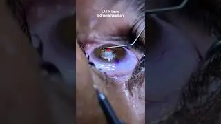 How LASIK Laser eye surgery is done 