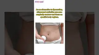 Can S Shape Cavitation Really Help with Belly Fat? Find Out How! #BodyGoals #mychway
