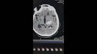 CT BRAIN PLAIN FILMING 