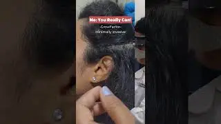 If hair loss is stressing you out and you’re looking for ways on how to treat it, here a quick guide