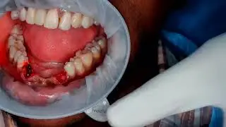 lower front teeth replacement with single piece Bcs Ex + compressive implant